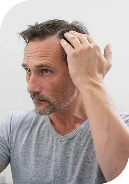 Man Is Thinking To Take Microneedling PEP Hairs Treatment