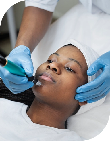 A Woman Going Through Microneedling Treatment