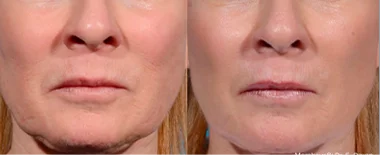Before and After Morpheus8 Treatment